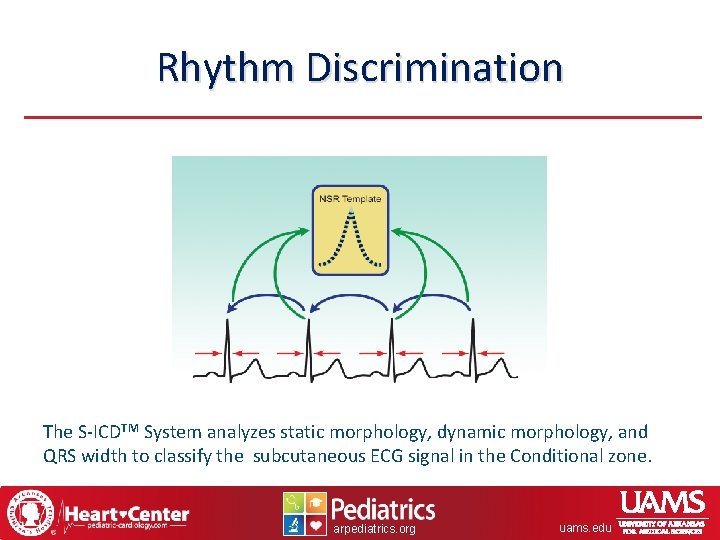 Rhythm Discrimination The S-ICDTM System analyzes static morphology, dynamic morphology, and QRS width to