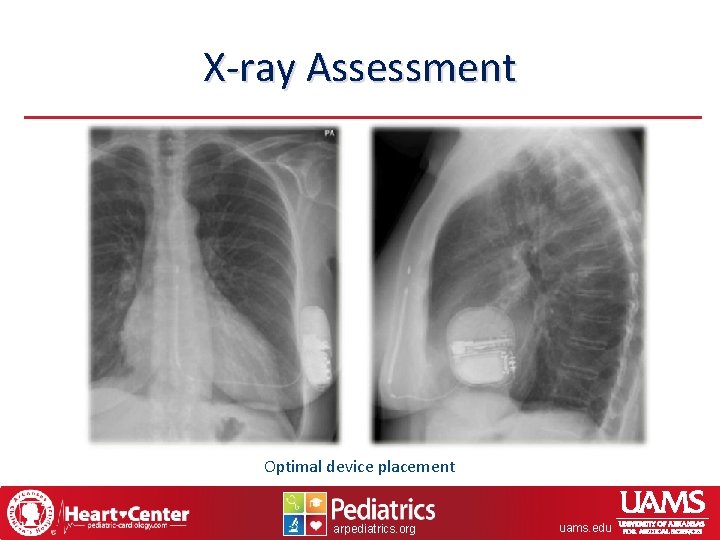 X-ray Assessment Optimal device placement arpediatrics. org uams. edu 