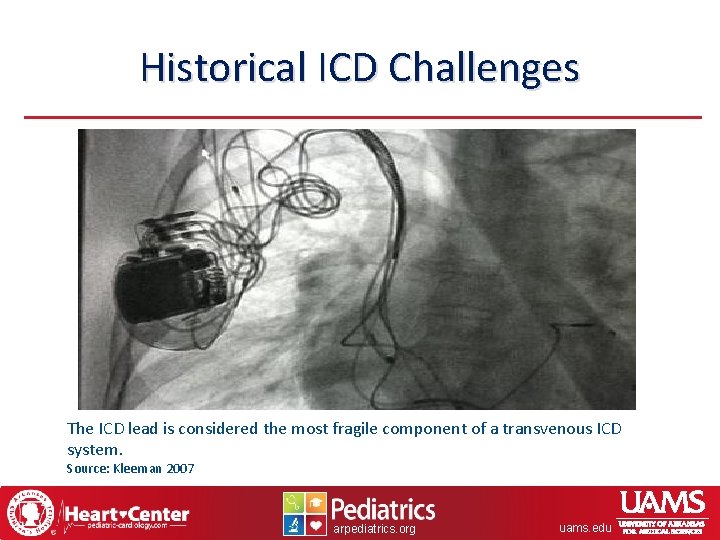 Historical ICD Challenges The ICD lead is considered the most fragile component of a