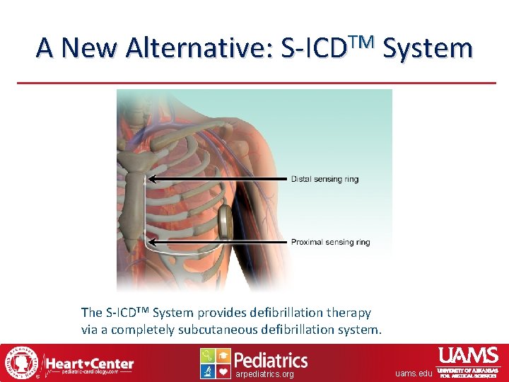 A New Alternative: S-ICDTM System The S-ICDTM System provides defibrillation therapy via a completely