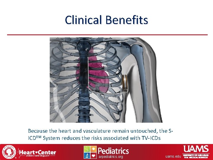 Clinical Benefits Because the heart and vasculature remain untouched, the SICDTM System reduces the