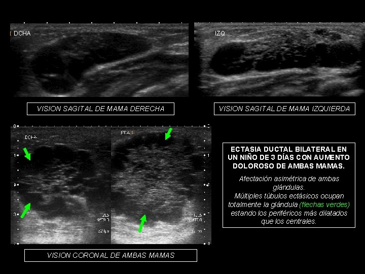 DCHA IZQ VISION SAGITAL DE MAMA DERECHA VISION SAGITAL DE MAMA IZQUIERDA ECTASIA DUCTAL