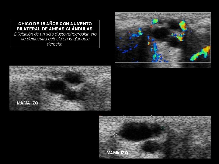 CHICO DE 15 AÑOS CON AUMENTO BILATERAL DE AMBAS GLÁNDULAS. Dilatación de un sólo