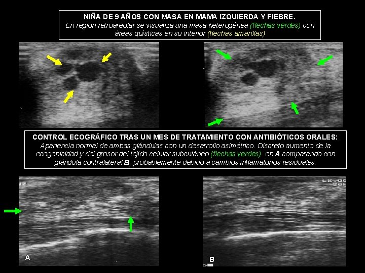 NIÑA DE 9 AÑOS CON MASA EN MAMA IZQUIERDA Y FIEBRE. En región retroareolar