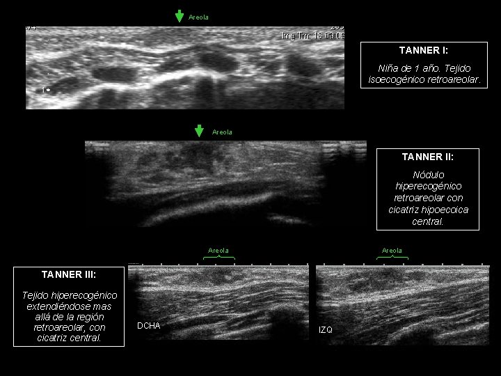 Areola TANNER I: Niña de 1 año. Tejido isoecogénico retroareolar. Areola TANNER II: Nódulo