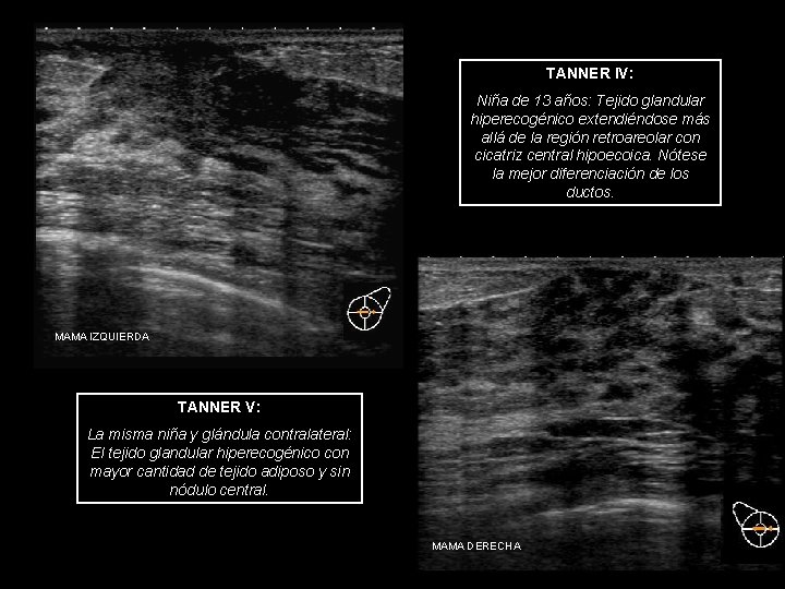 TANNER IV: Niña de 13 años: Tejido glandular hiperecogénico extendiéndose más allá de la