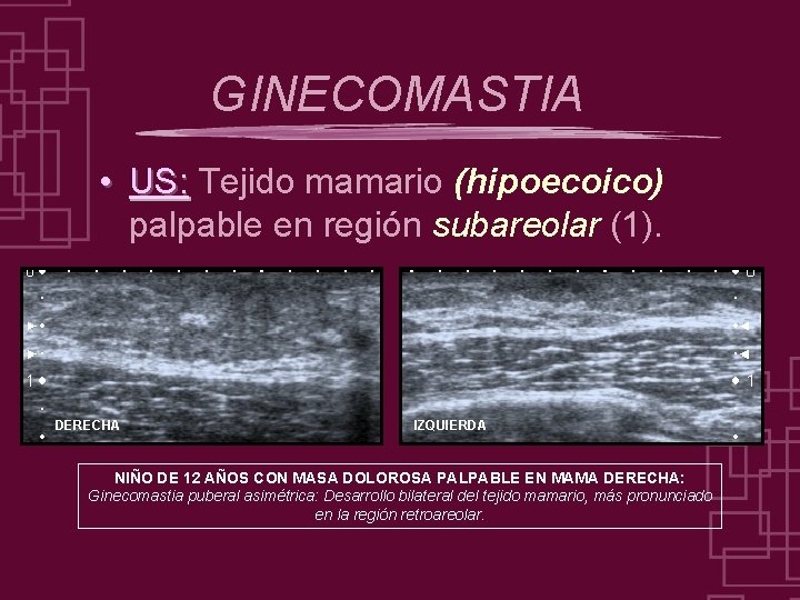 GINECOMASTIA • US: Tejido mamario (hipoecoico) palpable en región subareolar (1). DERECHA IZQUIERDA NIÑO