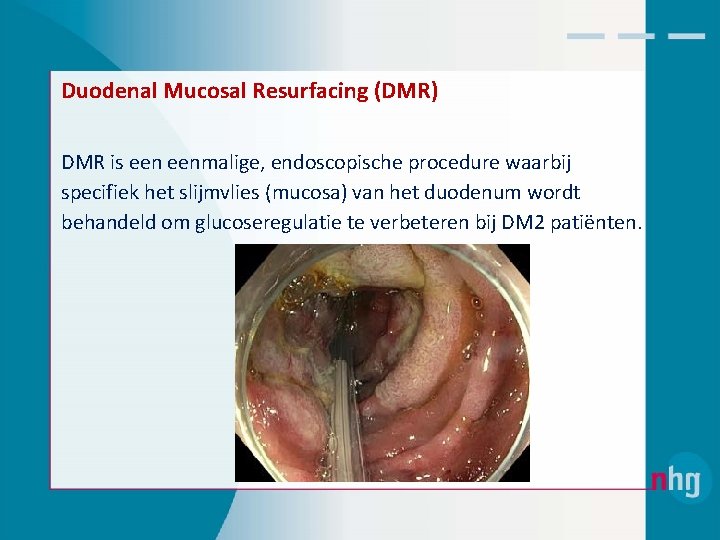 Duodenal Mucosal Resurfacing (DMR) DMR is eenmalige, endoscopische procedure waarbij specifiek het slijmvlies (mucosa)