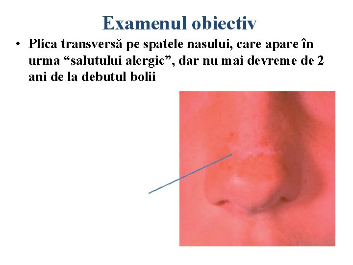 Examenul obiectiv • Plica transversă pe spatele nasului, care apare în urma “salutului alergic”,