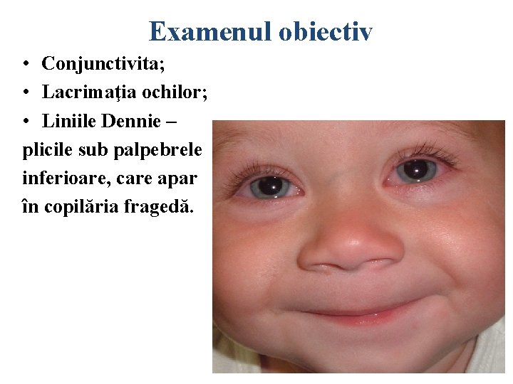 Examenul obiectiv • Conjunctivita; • Lacrimaţia ochilor; • Liniile Dennie – plicile sub palpebrele Examenul obiectiv • Conjunctivita; • Lacrimaţia ochilor; • Liniile Dennie – plicile sub palpebrele