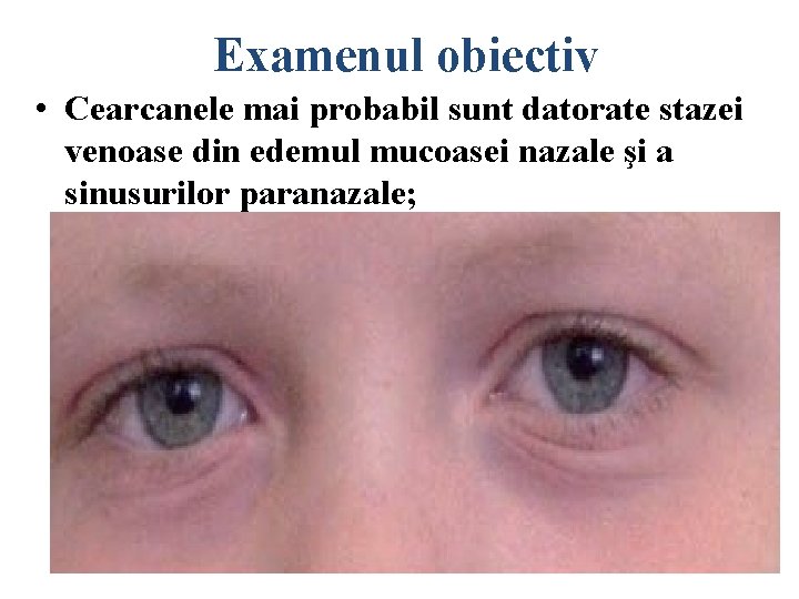 Examenul obiectiv • Cearcanele mai probabil sunt datorate stazei venoase din edemul mucoasei nazale