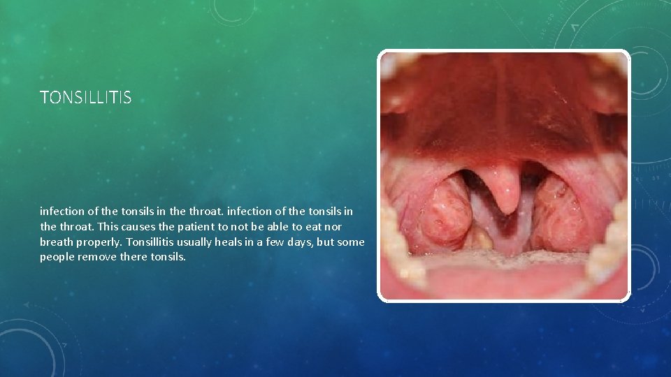 TONSILLITIS infection of the tonsils in the throat. This causes the patient to not