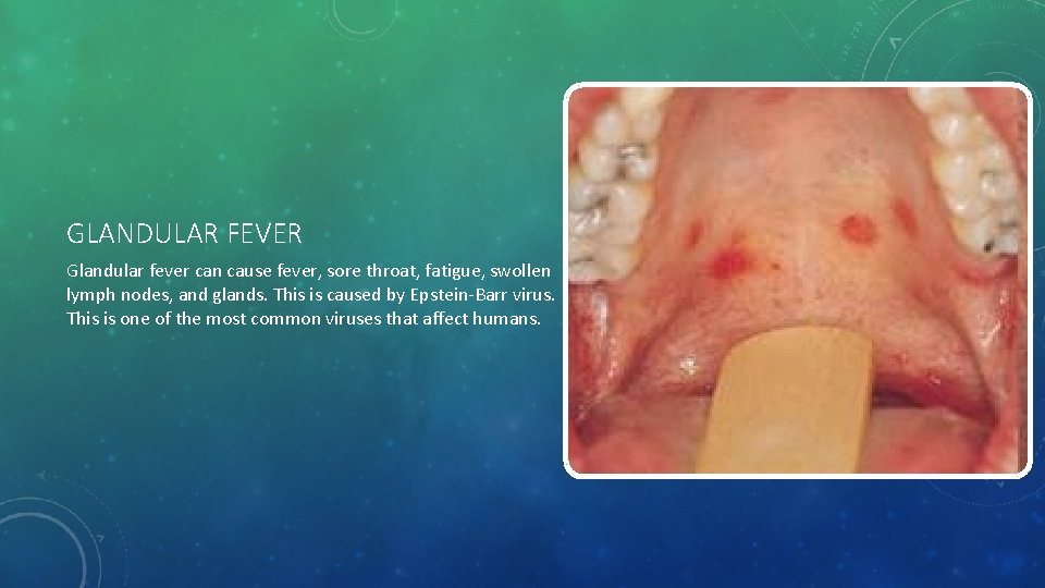GLANDULAR FEVER Glandular fever can cause fever, sore throat, fatigue, swollen lymph nodes, and