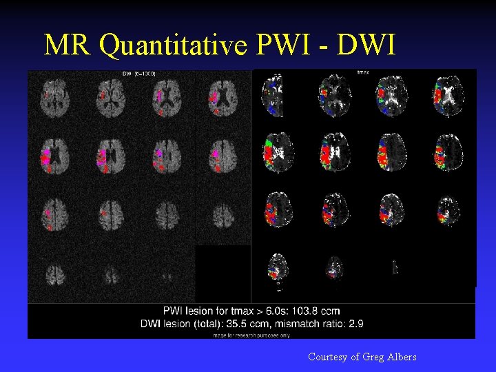 MR Quantitative PWI - DWI Courtesy of Greg Albers 