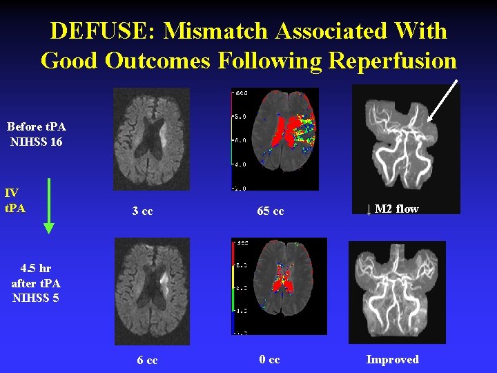 DEFUSE: Mismatch Associated With Good Outcomes Following Reperfusion Before t. PA NIHSS 16 IV