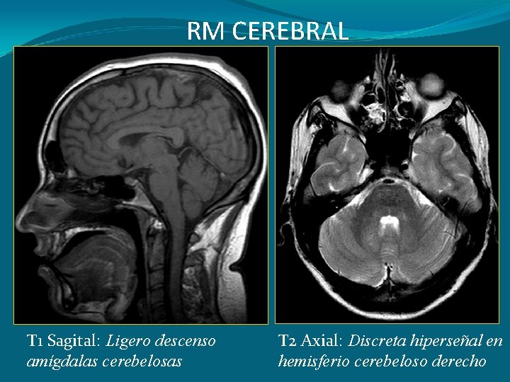 RM CEREBRAL T 1 Sagital: Ligero descenso amígdalas cerebelosas T 2 Axial: Discreta hiperseñal