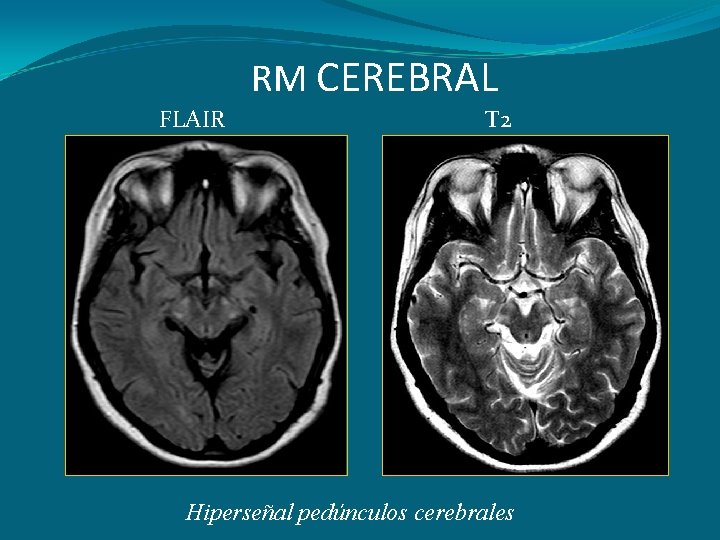 RM CEREBRAL FLAIR T 2 Hiperseñal pedúnculos cerebrales 