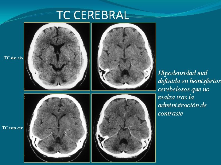 TC CEREBRAL TC sin civ Hipodensidad mal definida en hemisferios cerebelosos que no realza