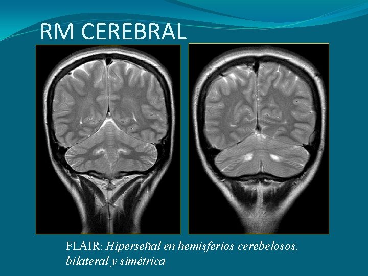 RM CEREBRAL FLAIR: Hiperseñal en hemisferios cerebelosos, bilateral y simétrica 