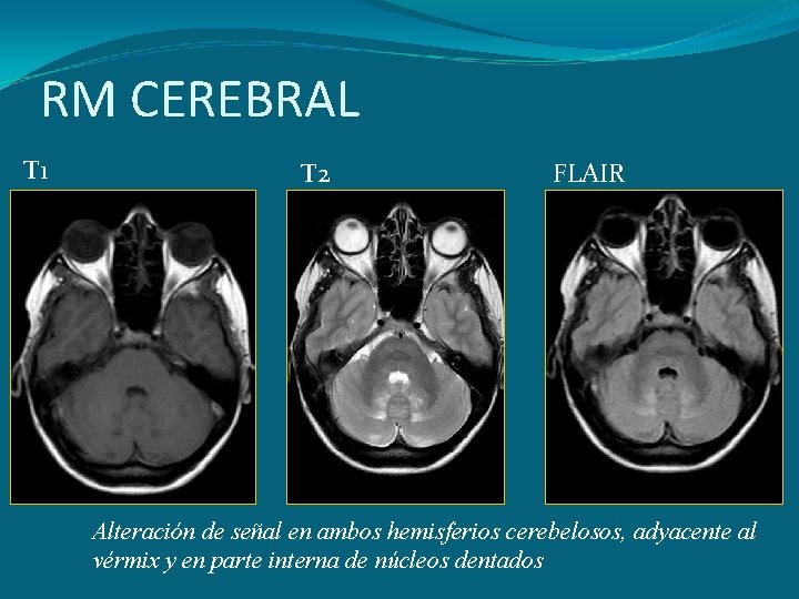 RM CEREBRAL T 1 T 2 FLAIR Alteración de señal en ambos hemisferios cerebelosos,
