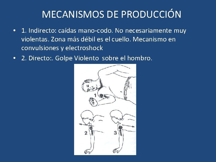 MECANISMOS DE PRODUCCIÓN • 1. Indirecto: caídas mano-codo. No necesariamente muy violentas. Zona más