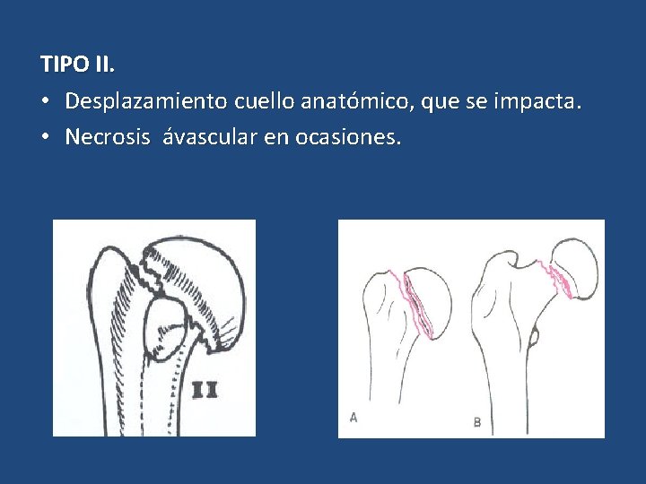 TIPO II. • Desplazamiento cuello anatómico, que se impacta. • Necrosis ávascular en ocasiones.