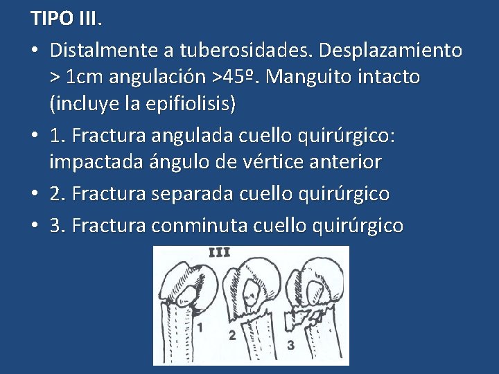 TIPO III. • Distalmente a tuberosidades. Desplazamiento > 1 cm angulación >45º. Manguito intacto