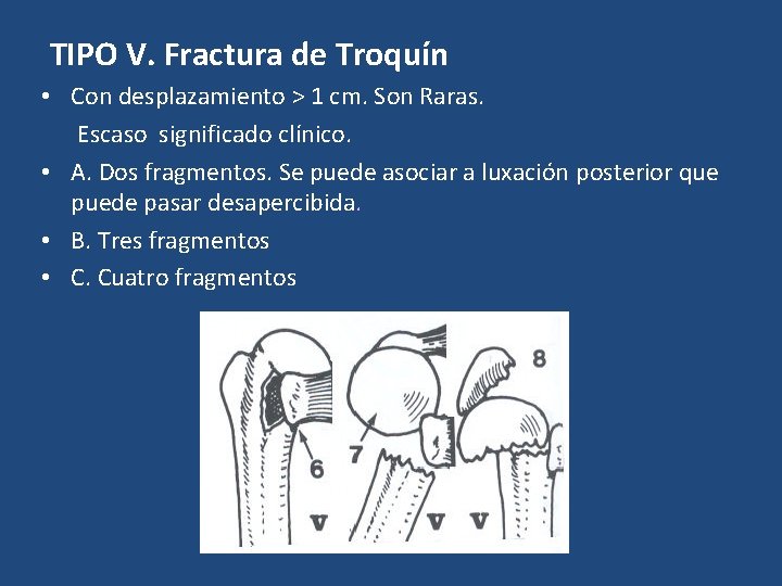 TIPO V. Fractura de Troquín • Con desplazamiento > 1 cm. Son Raras. Escaso