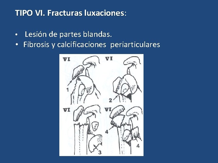 TIPO VI. Fracturas luxaciones: • Lesión de partes blandas. • Fibrosis y calcificaciones periarticulares