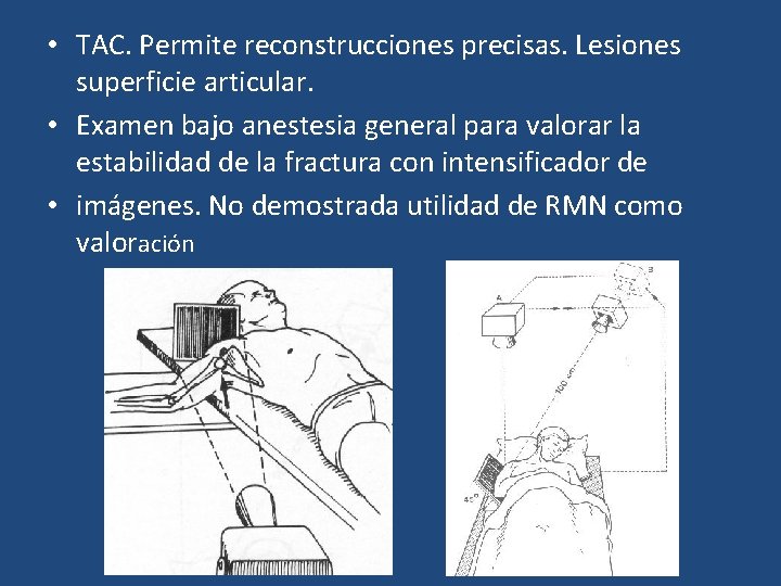  • TAC. Permite reconstrucciones precisas. Lesiones superficie articular. • Examen bajo anestesia general