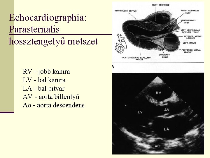 Echocardiographia: Parasternalis hossztengelyű metszet RV - jobb kamra LV - bal kamra LA -