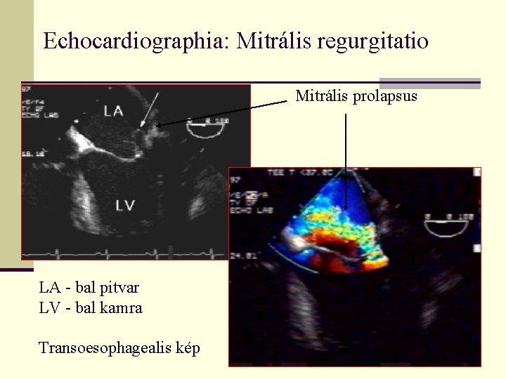 Echocardiographia: Mitrális regurgitatio Mitrális prolapsus LA - bal pitvar LV - bal kamra Transoesophagealis