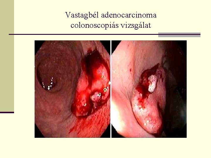 Vastagbél adenocarcinoma colonoscopiás vizsgálat 