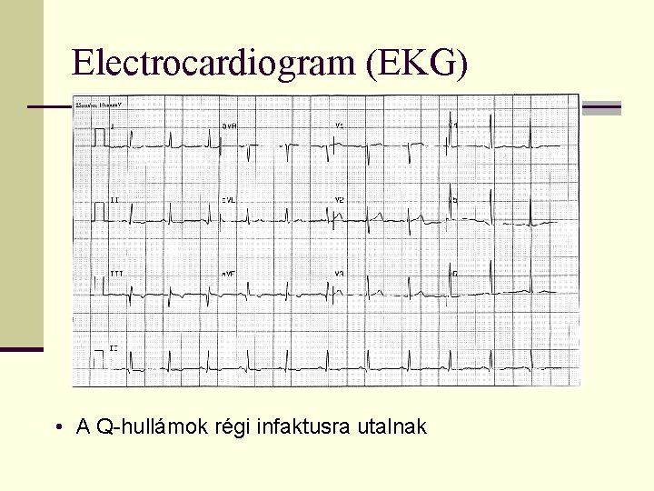 Electrocardiogram (EKG) • A Q-hullámok régi infaktusra utalnak 