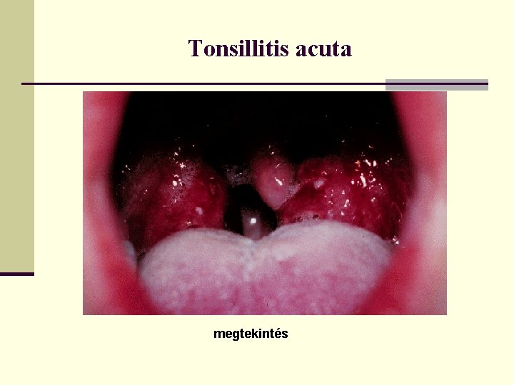 Tonsillitis acuta megtekintés 
