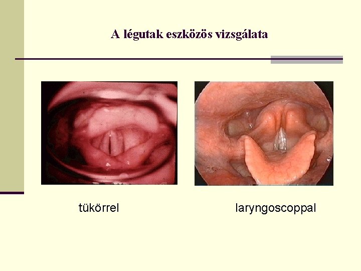 A légutak eszközös vizsgálata tükörrel laryngoscoppal 