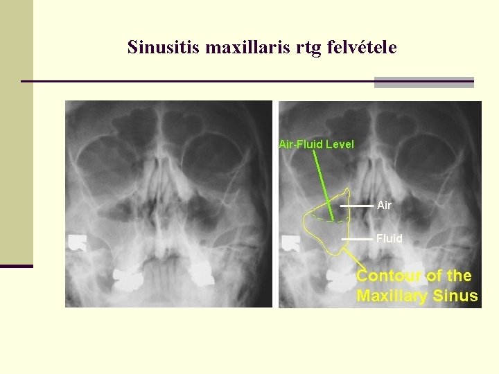 Sinusitis maxillaris rtg felvétele 