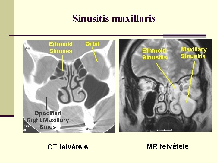 Sinusitis maxillaris CT felvétele MR felvétele 