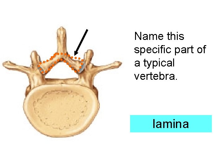 Name this specific part of a typical vertebra. lamina 