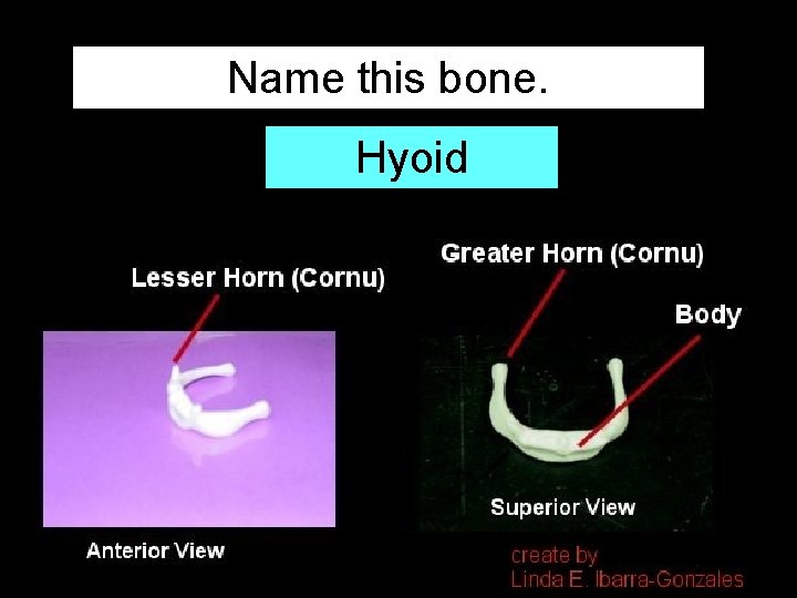 Name this bone. Hyoid 