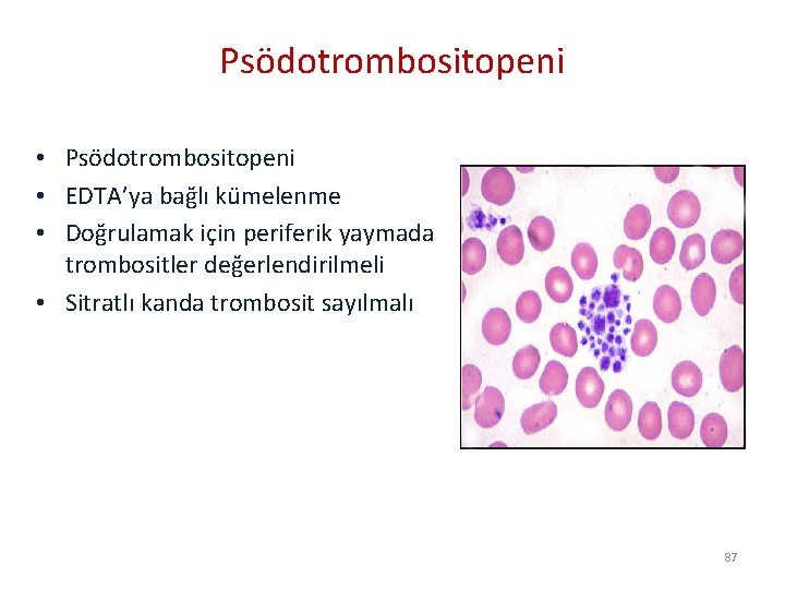 Psödotrombositopeni • EDTA’ya bağlı kümelenme • Doğrulamak için periferik yaymada trombositler değerlendirilmeli • Sitratlı