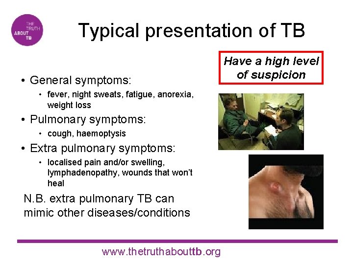 Typical presentation of TB • General symptoms: • fever, night sweats, fatigue, anorexia, weight