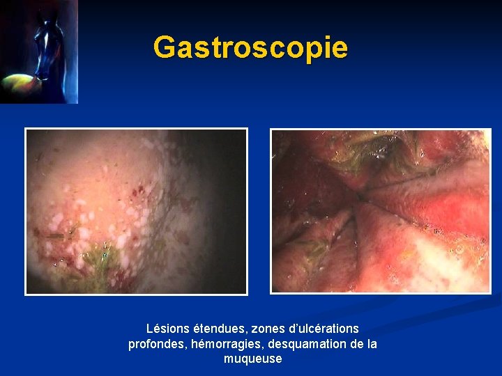 Gastroscopie Lésions étendues, zones d’ulcérations profondes, hémorragies, desquamation de la muqueuse 
