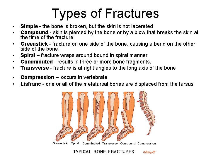 Types of Fractures • • • Simple - the bone is broken, but the