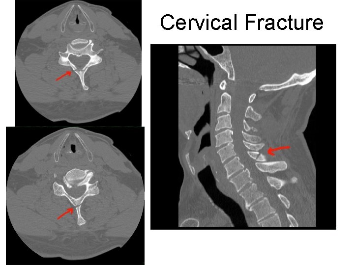 Cervical Fracture 