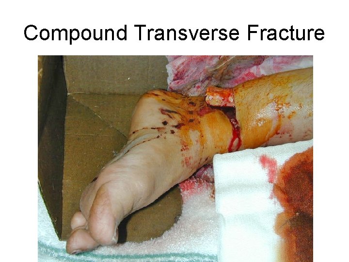 Compound Transverse Fracture 