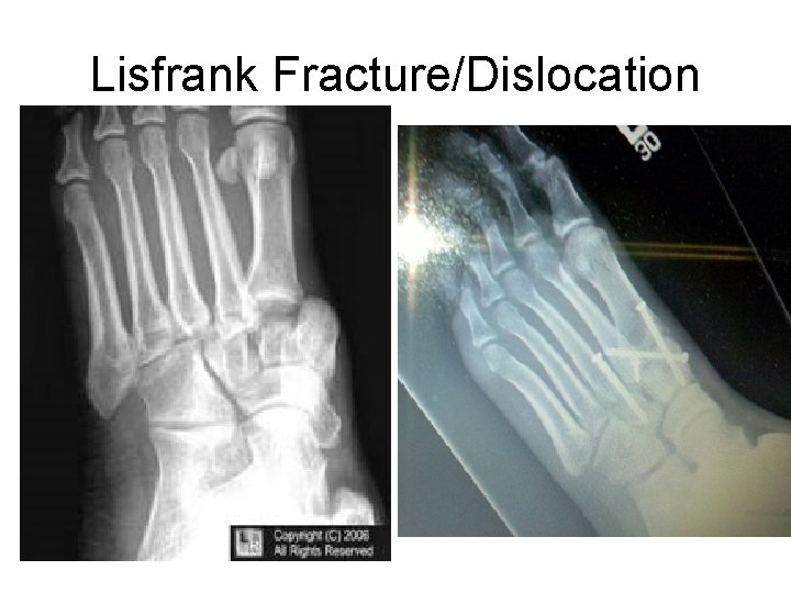 Lisfrank Fracture/Dislocation 