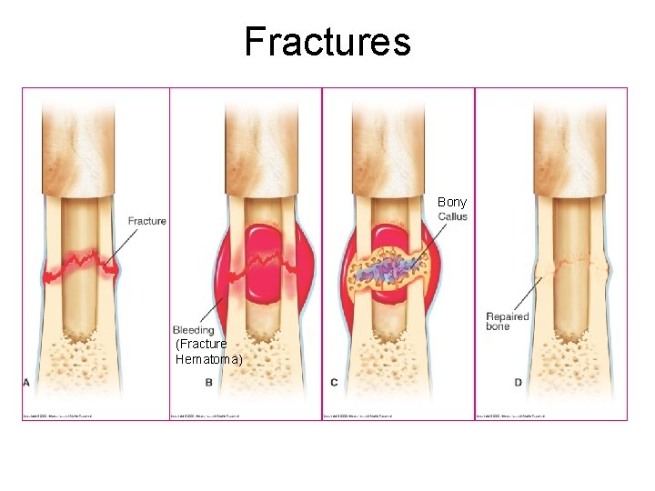 Fractures Bony (Fracture Hematoma) 