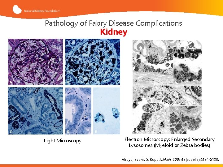 Pathology of Fabry Disease Complications Kidney Light Microscopy Electron Microscopy: Enlarged Secondary Lysosomes (Myeloid