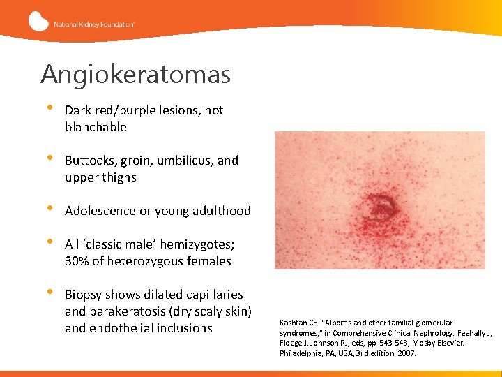 Angiokeratomas • Dark red/purple lesions, not blanchable • Buttocks, groin, umbilicus, and upper thighs